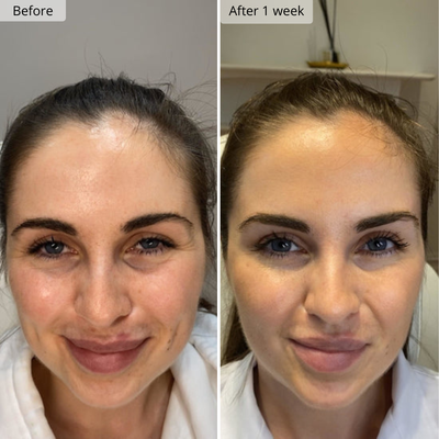 Micro-Infusion Patches