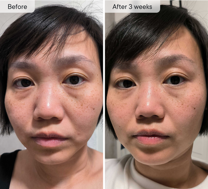 Micro-Infusion Patches